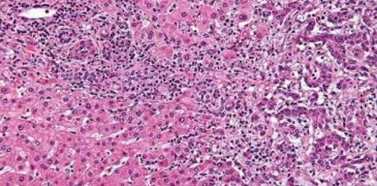 Identifican dos subtipos del cáncer hepático más agresivo 