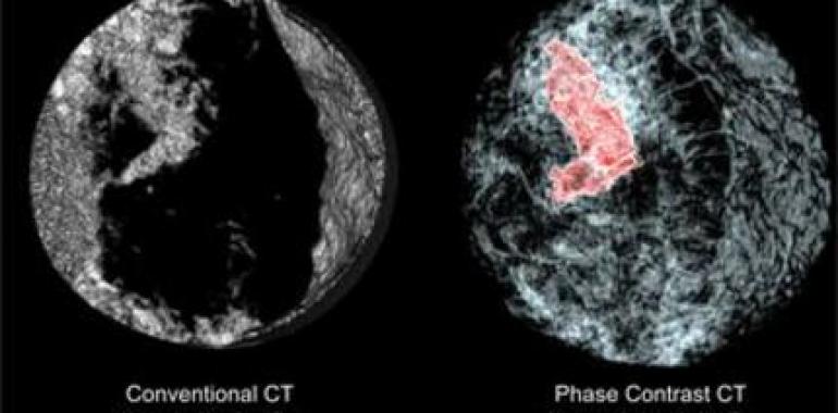  Las cifras de incidencia y mortalidad por cáncer en España son, en general, inferiores a las de la UE