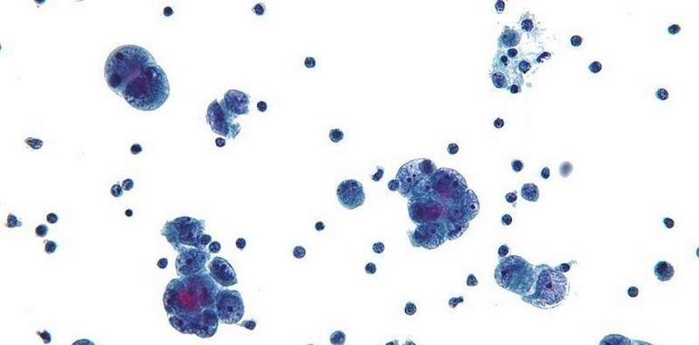 El análisis genómico del cáncer de ovario arroja nuevas pistas