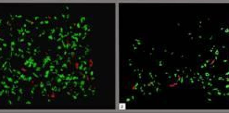 La sinapsis neuronal es cinco veces menor en las zonas del cerebro afectadas por  Alzheimer