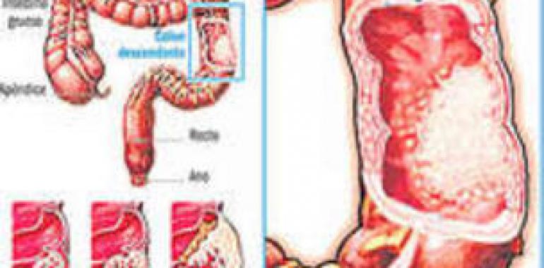 Conferencia de Alejo Mancebo y Pilar Varela sobre Cáncer de colon: prevención y diagnóstico