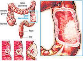 Conferencia de Alejo Mancebo y Pilar Varela sobre \Cáncer de colon: prevención y diagnóstico\