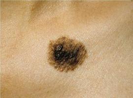 Aumenta el cáncer de piel por exposición solar