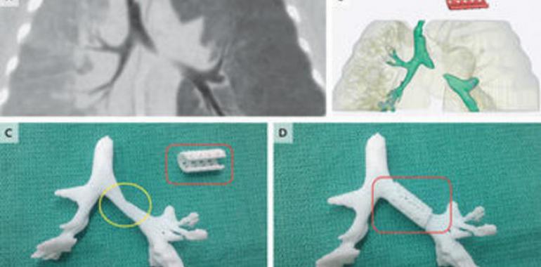 Salvan la vida de un bebé con un dispositivo salido de una impresora 3D (VIDEO)