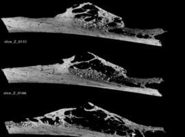 La enfermedad neoplásica del hermano Neandertal