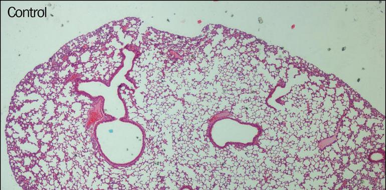 Una nueva terapia experimental reduce en un 90 % la metástasis de melanoma en el pulmón