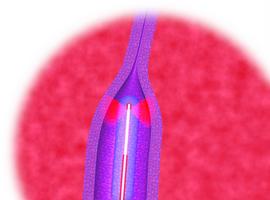Novedoso tratamiento en Valvuloplastia con un láser de biolitec