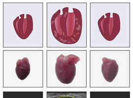 Un nuevo fármaco optimiza el tratamiento de la insuficiencia cardiaca