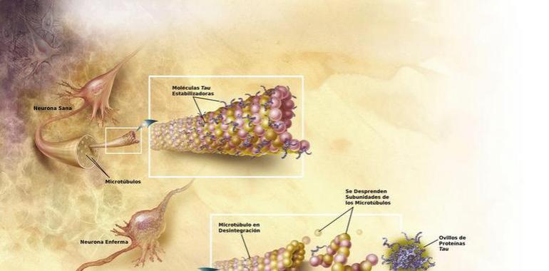 Una nueva terapia retrasa la evolución del Alzhéimer