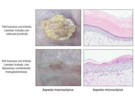 Un posible tratamiento para la Ictiosis lamelar