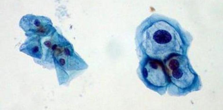 Decisiva contribución de investigadores asturianos a la prevención del cáncer orofaríngeo