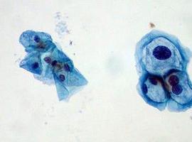 Decisiva contribución de investigadores asturianos a la prevención del cáncer orofaríngeo