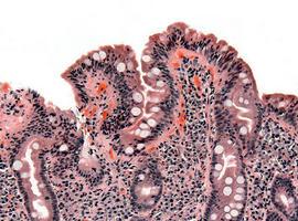 Avances en la detección de enfermedad celiaca en adultos 