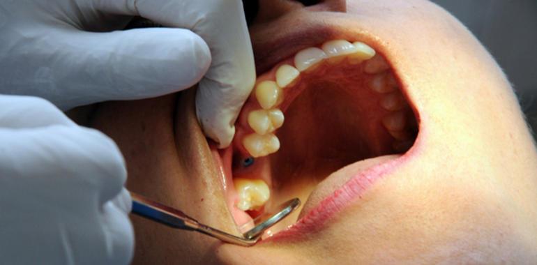 El exceso de zinc en los adhesivos para empastes dentales reduce su eficacia