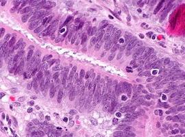 ONU pide más prevención y detección precoz contra el cáncer