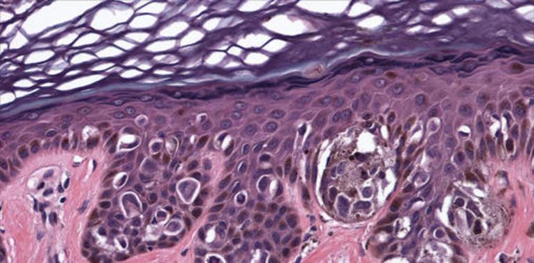 Patentan un método de diagnóstico precoz del melanoma