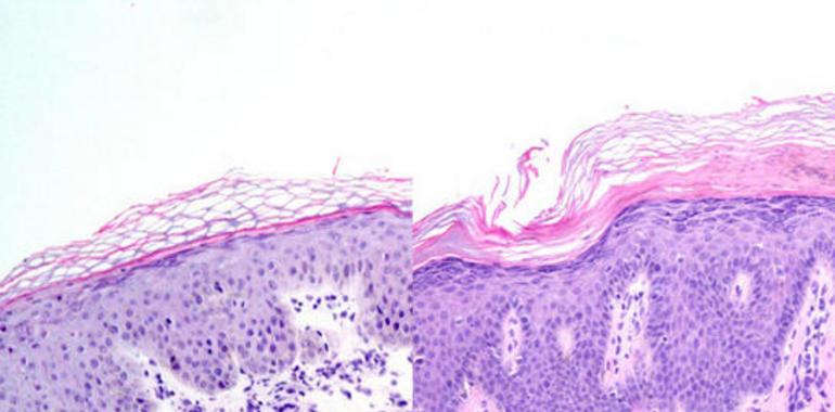 Fármacos comerciales para curar la psoriasis sin apenas efectos secundarios