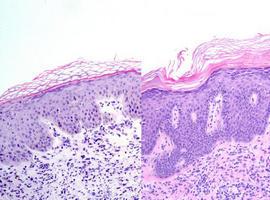 Fármacos comerciales para curar la psoriasis sin apenas efectos secundarios