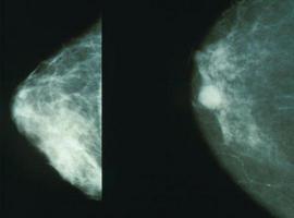La mejora en el cribado del cáncer de mama aumenta la eficacia de la diagnosis