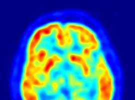 El HUCA está en la vanguardia de la investigación del parkinson