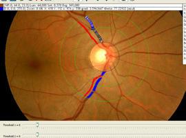 Instituto Fernández-Vega presenta los últimos avances en retina y vítreo
