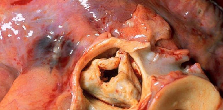 El HUCA, pionero en España en la implantación de una nueva válvula aórtica transcatéter