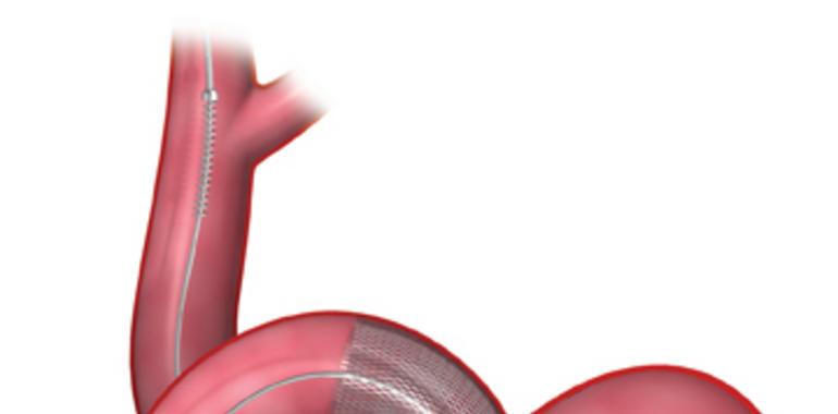 Dos pacientes del HUCA, pioneros en recibir un nuevo stent cerebral para aneurismas