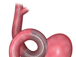 Dos pacientes del HUCA, pioneros en recibir un nuevo stent cerebral para aneurismas