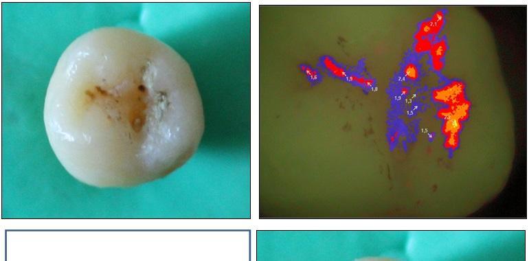 El programa asturiano de Salud Bucodental evita las caries a 9 de cada 10 niños