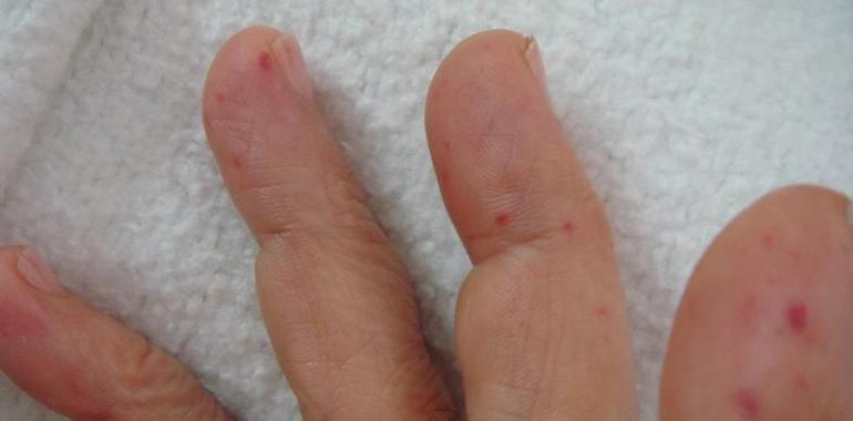 Descubren que un fármaco de la osteoporosis es útil contra una enfermedad rara