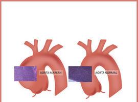 Descubren la causa de la rigidez de la aorta en el #síndrome de #Marfan