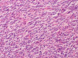 Dos cannabinoides resultan efectivos para potenciar la muerte de células tumorales de melanomas