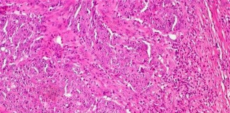 Nuevo fármaco con efecto antitumoral contra el cáncer de colon y el melanoma