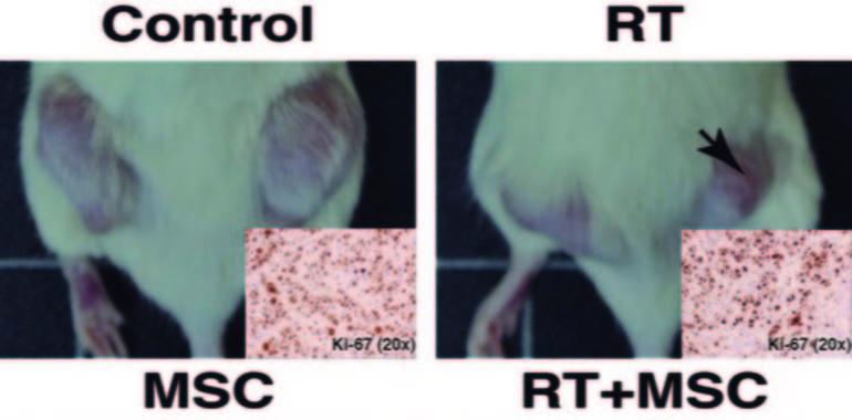 Combinación de radioterapia y terapia con células madre contra el cáncer
