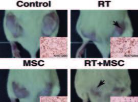 Combinación de radioterapia y terapia con células madre contra el cáncer