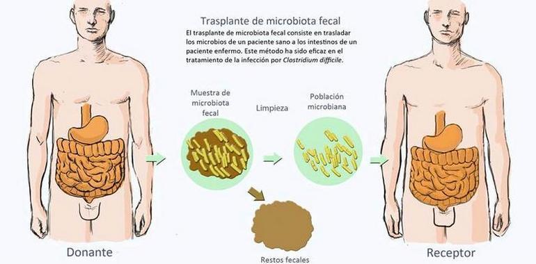 Una nueva técnica mejora la eficacia del trasplante de microbiota fecal intestinal