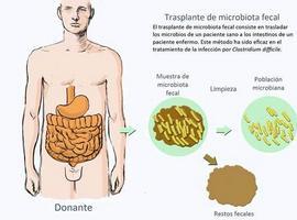 Una nueva técnica mejora la eficacia del trasplante de microbiota fecal intestinal