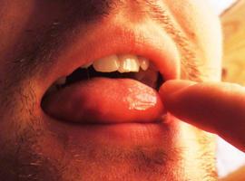 Un biosensor logra identificar cáncer oral en muestras de saliva