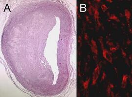 Investigadores españoles descubren una molécula que provoca arteriosclerosis