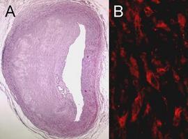 Investigadores españoles descubren una molécula que provoca arteriosclerosis