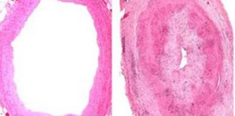Identificados dos genes de riesgo para padecer arteritis de células gigantes
