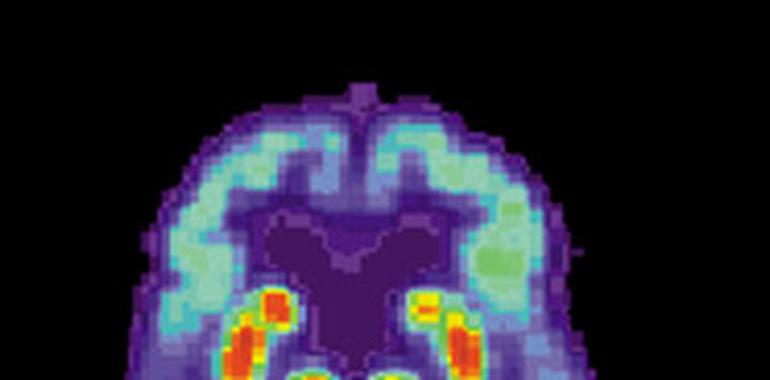 Indicios de que el alzheimer puede ser infeccioso