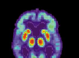 Indicios de que el alzheimer puede ser infeccioso