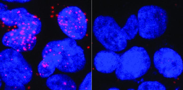 Nueva vía para combatir el cáncer de próstata avanzado