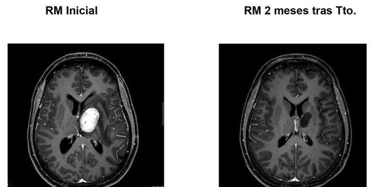 Valdecilla: Radiocirugía en tumores y anormalidades funcionales cerebrales