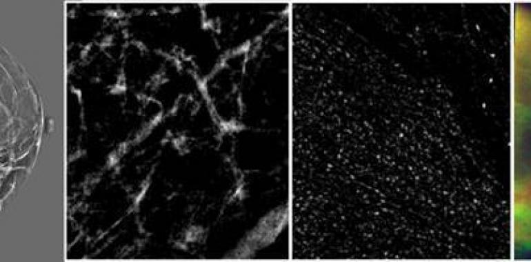 Nuevo sistema de ayuda al diagnóstico del cáncer de mama basado en inteligencia artificial