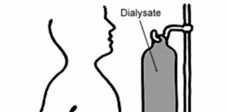 La diálisis peritoneal es prevalente para el tratamiento renal en Asturias
