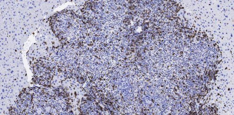 Inmunoterapia e inhibidor hormonal contra tumores de colon agresivos