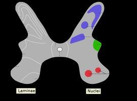 Avanzan en el tratamiento del dolor neuropático