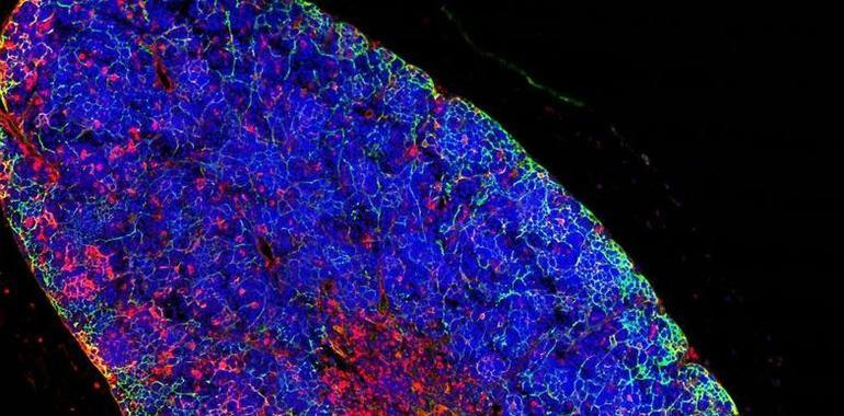 Generan por primera vez una leucemia humana de linfocitos T a partir de una célula sana